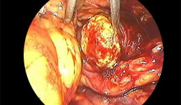 Obstrucción uretral