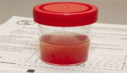 Hematuria