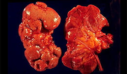 Infección renal