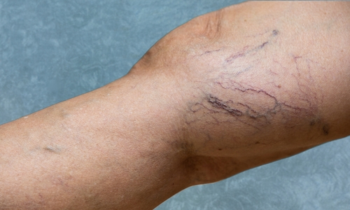 Legs with varicose